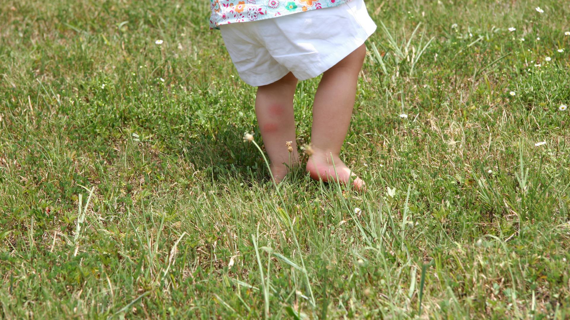 Grasmilben-Stiche auf einem Bein eines Kindes.