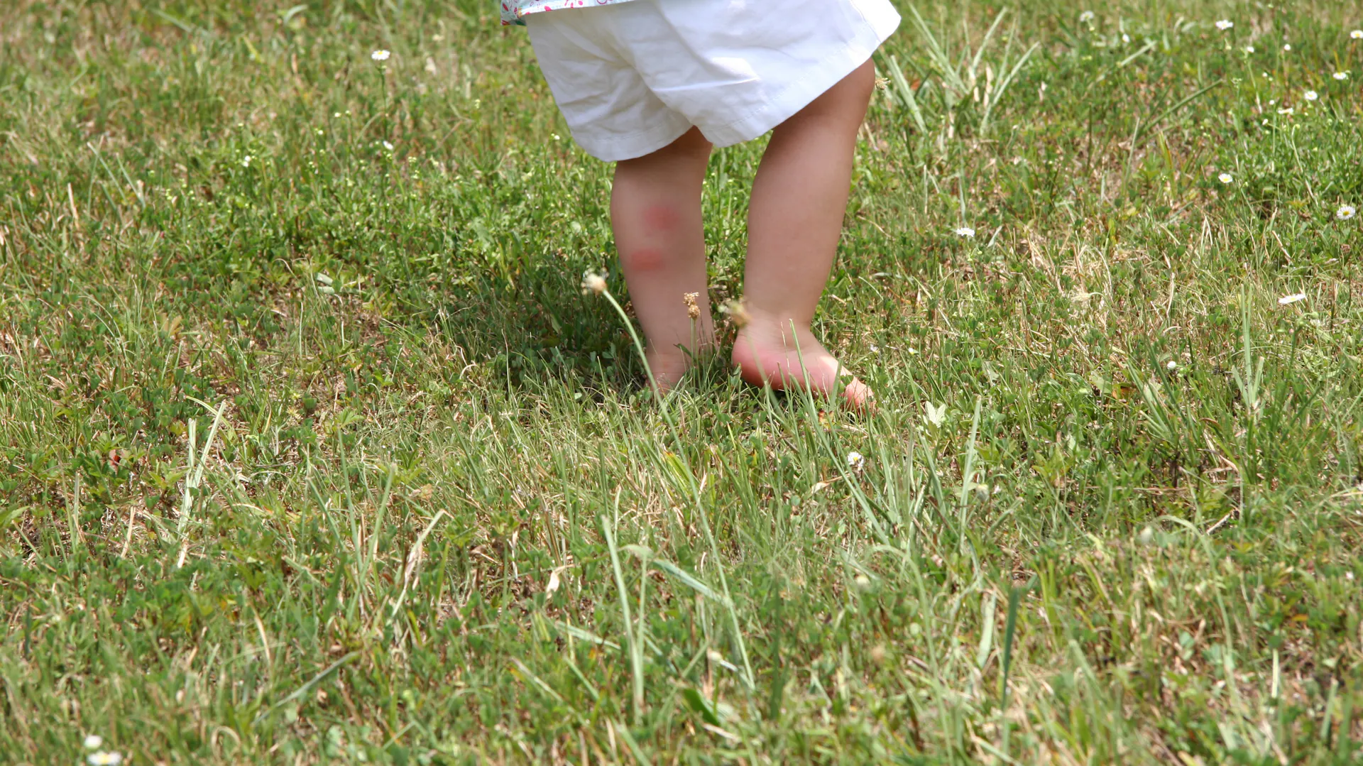 Grasmilben an Kinderbeinen